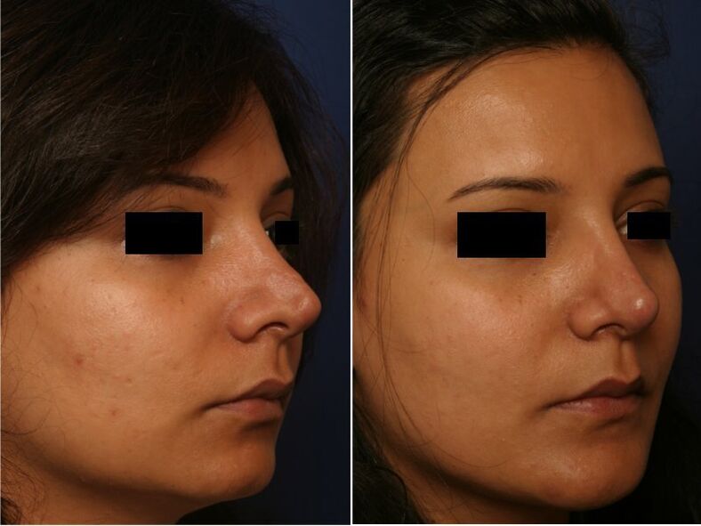 результат пластичних операцій