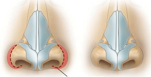 Зменшення ніздрів