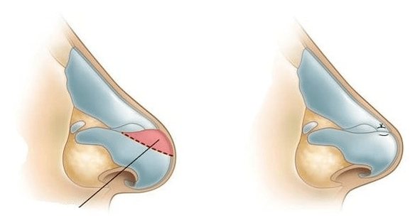 Корекція форми носа