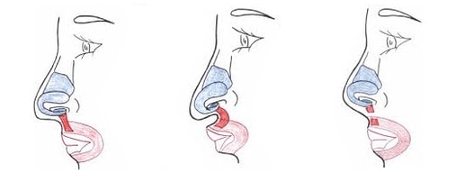 Усічення частини носового м'яза