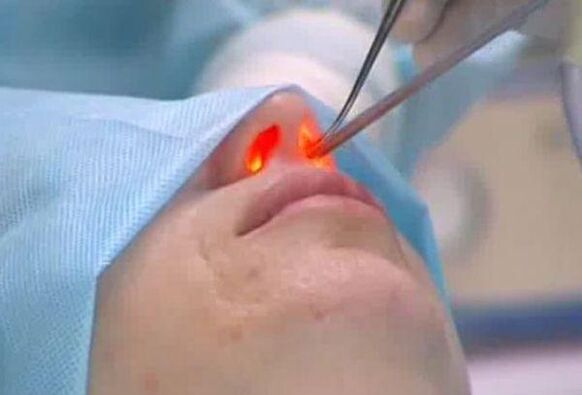 лазерна ринопластика носа