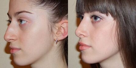 фото до і після проведення ринопластики носа