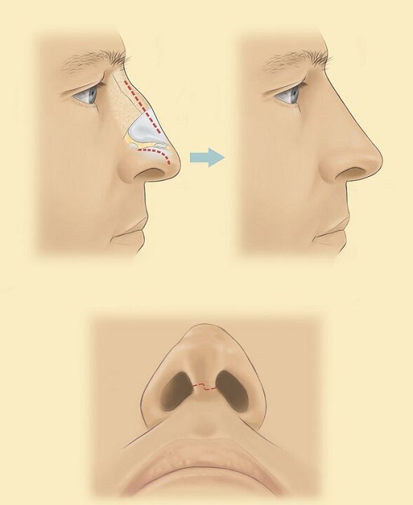 схема проведення ринопластики носа