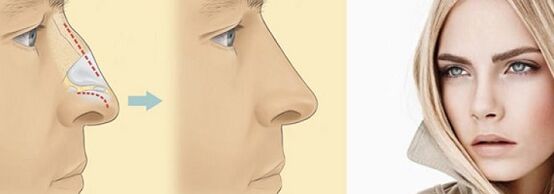 корекція форми носа безопераційної ринопластикою