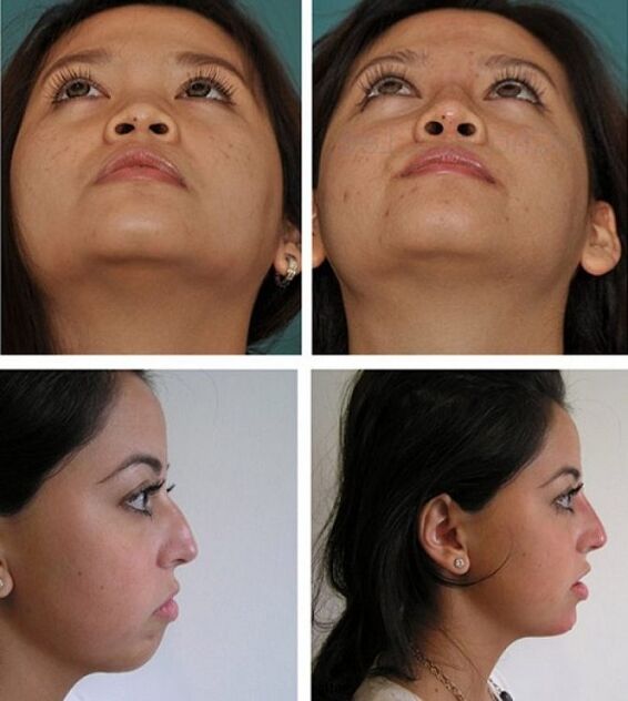 фото до і після ринопластики без операції