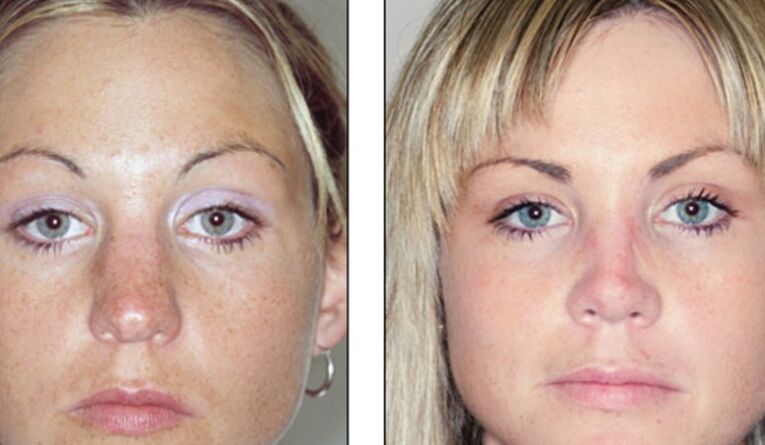До та після невдалої ринопластики носа