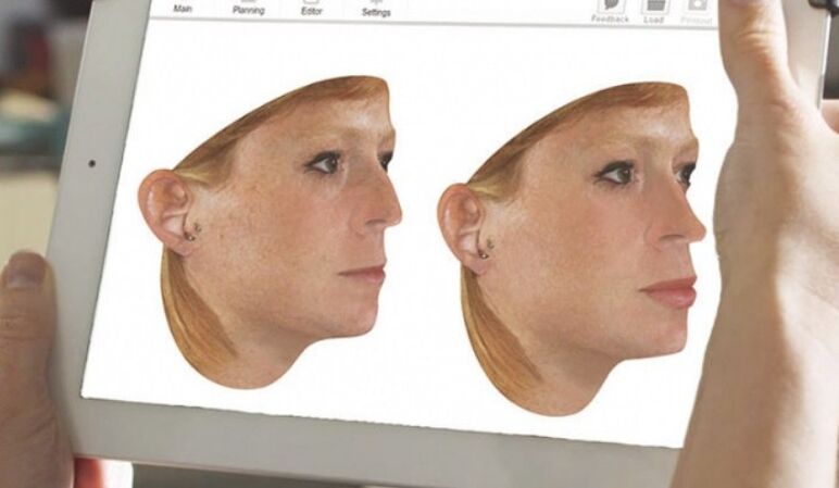 Метод комп'ютерного моделювання носа перед проведенням ринопластики
