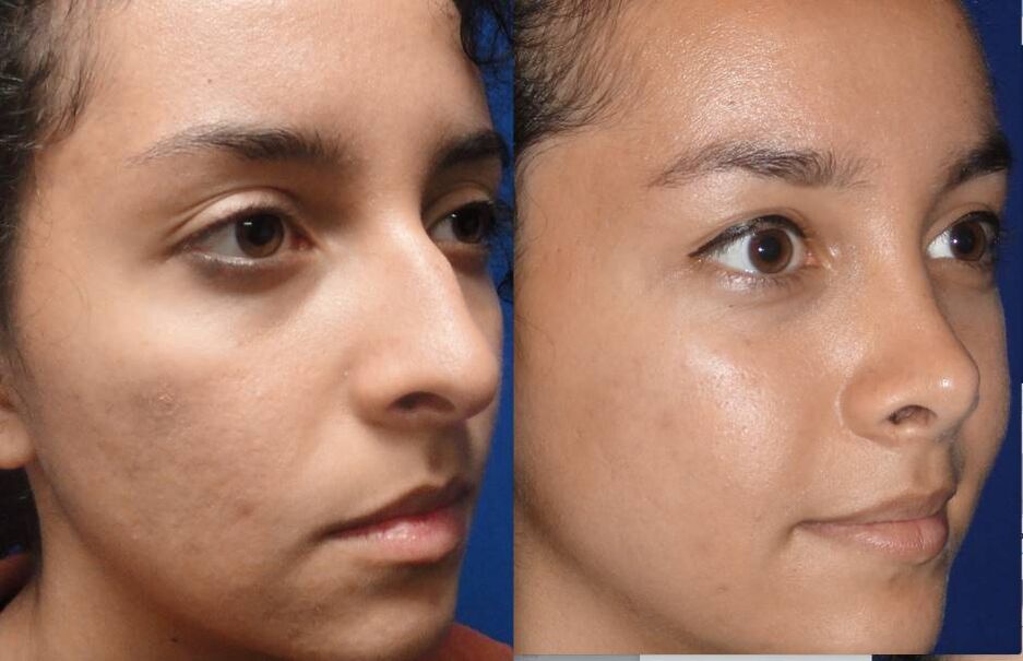 фото до та після закритої ринопластики носа
