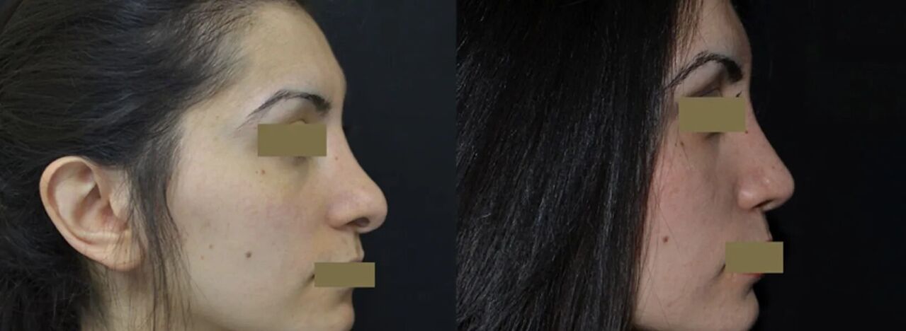 до та після ринопластики носа