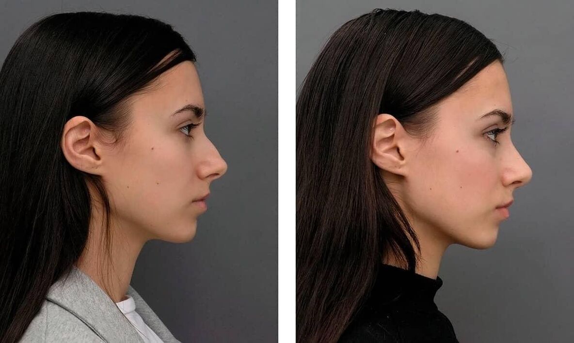 фото до та після пластики носа