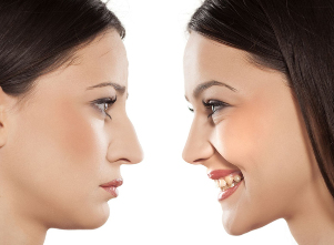 Ринопластика носа до і після