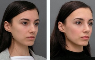 Дівчина до і після ринопластики носа